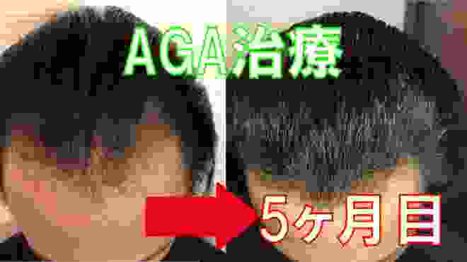 AGA治療5ヶ月目～産毛も育ってきて髪のボリュームが増えてきた～