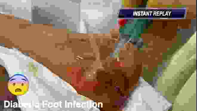 diabetic foot infection v2